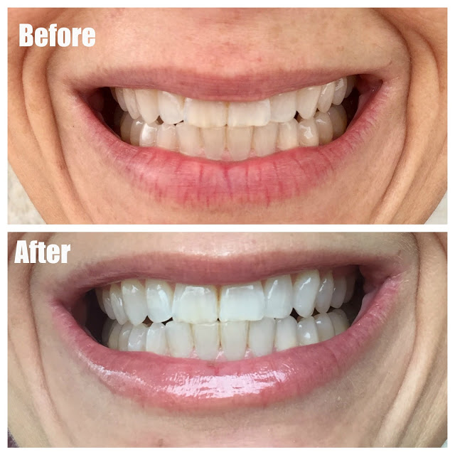 Smile Brilliant Whitening Review